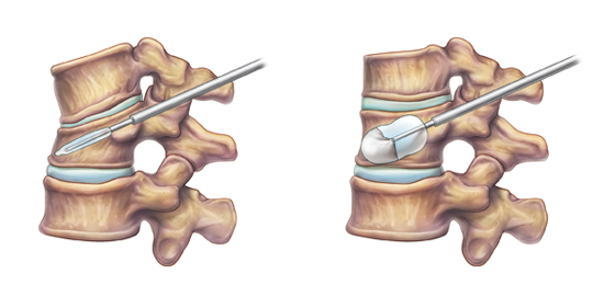 Osteoporosis spine fracture treatment and bone health care in Jaipur