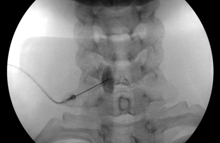 Image-guided stellate ganglion block treatment for sympathetic nerve pain and CRPS in Jaipur